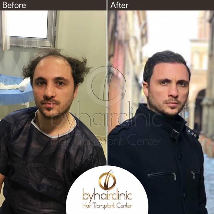 hair transplant turkey before after