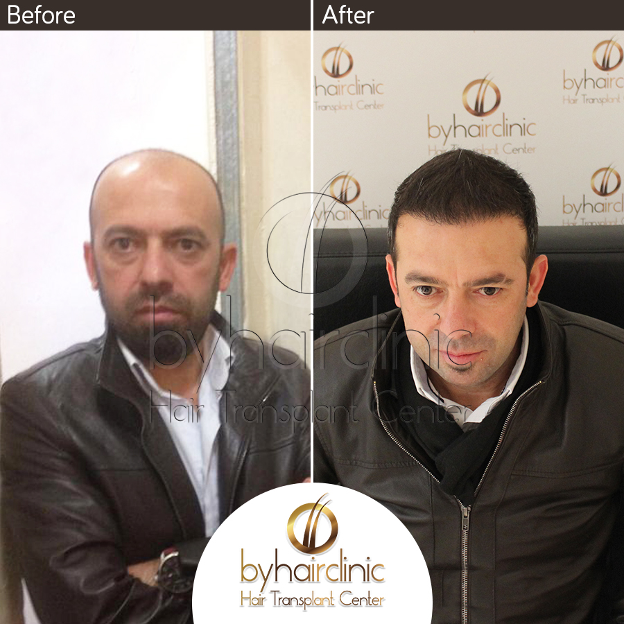hair transplant turkey before after