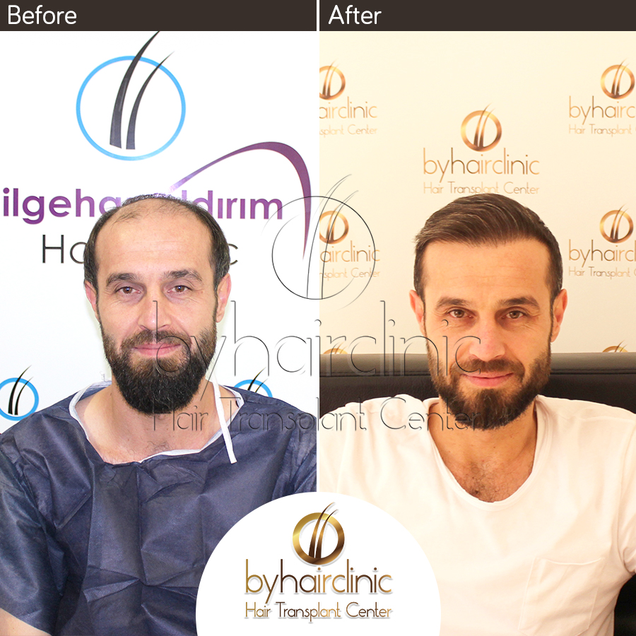 Home – bysacekimi hair transplantation in istanbul Turkey