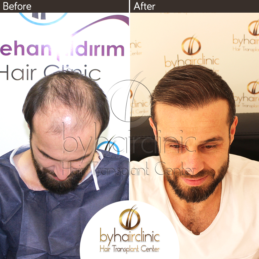 Hair Transplant Before After – bysacekimi hair transplantation in istanbul  Turkey