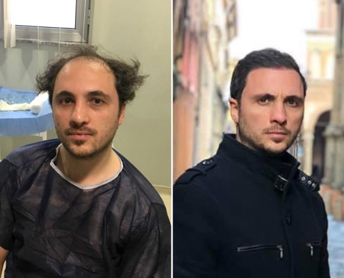 Hair transplants in Turkey: low cost, high quality - ABC Money