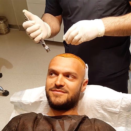 Haartransplantation Turkey Verarbeiten